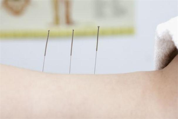 針灸減肥安全嗎 針灸減肥會(huì)影響生育嗎 針灸減肥安全嗎 針灸減肥會(huì)影響生育嗎
