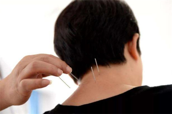 針灸減肥安全嗎 針灸減肥會(huì)影響生育嗎 針灸減肥安全嗎 針灸減肥會(huì)影響生育嗎