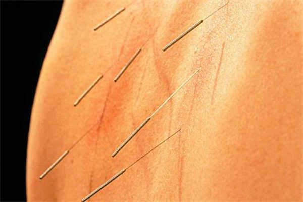 針灸減肥可以抽煙喝酒嗎 針灸減肥如何控制飲食 針灸減肥可以抽煙喝酒嗎 針灸減肥如何控制飲食