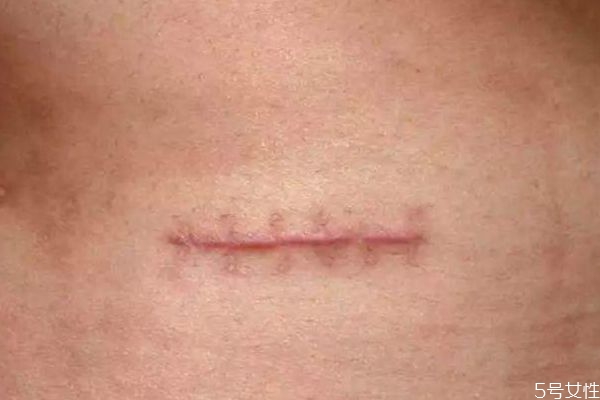 去除疤痕的方法 快速恢復(fù)疤痕的辦法 去除疤痕的方法 快速恢復(fù)疤痕的辦法