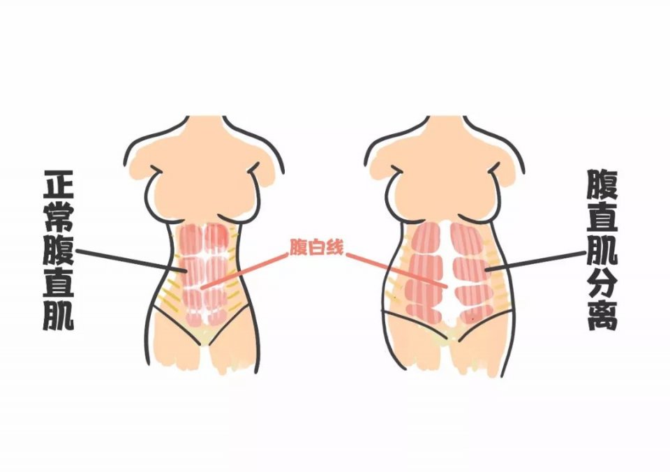 腹直肌怎么練 鍛煉腹直肌的方法 腹直肌怎么練 鍛煉腹直肌的方法
