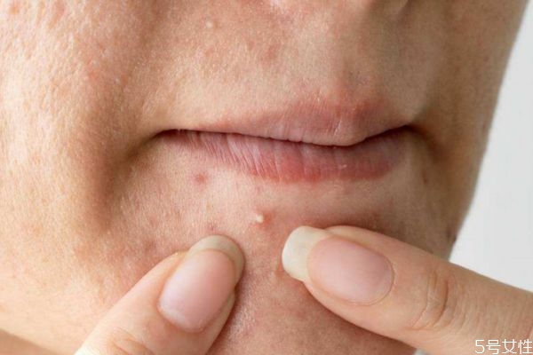 痘痘發(fā)炎怎么辦 痘痘發(fā)炎怎么解決 痘痘發(fā)炎怎么辦 痘痘發(fā)炎怎么解決