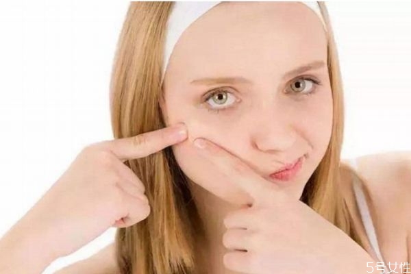 去痘痘可以用手擠嗎 手可以擠痘痘嗎 去痘痘可以用手擠嗎 手可以擠痘痘嗎