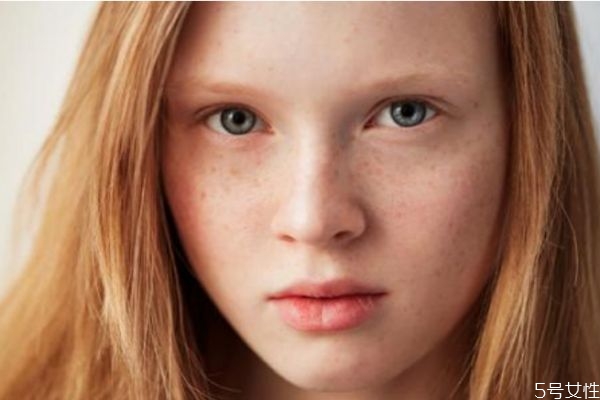 皮膚發(fā)黃的原因有什么 皮膚發(fā)黃的原因有什么