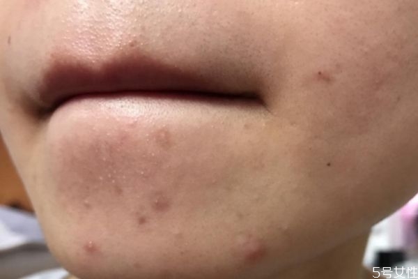 下巴的粉刺應(yīng)該怎么去除 去除下巴粉刺的方法 下巴的粉刺應(yīng)該怎么去除 去除下巴粉刺的方法