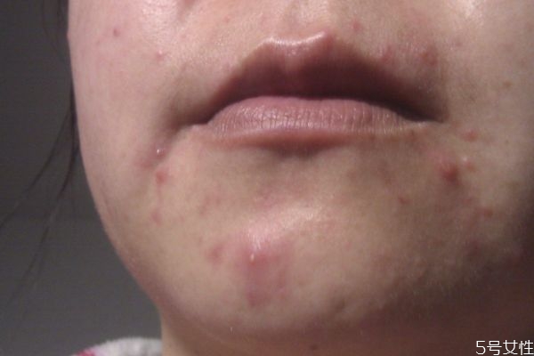 下巴的粉刺應(yīng)該怎么去除 去除下巴粉刺的方法 下巴的粉刺應(yīng)該怎么去除 去除下巴粉刺的方法