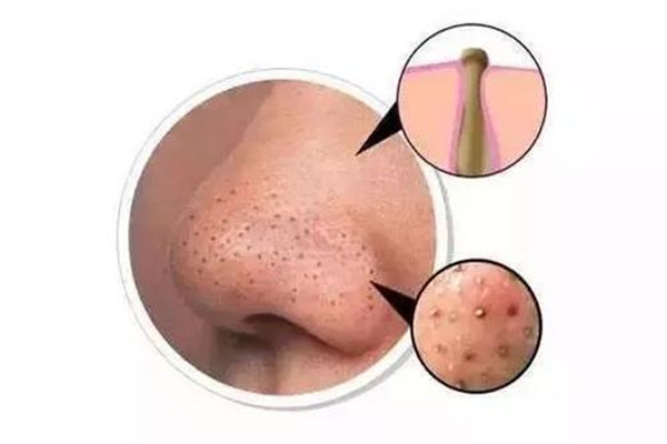 有草莓鼻怎么辦 草莓鼻怎么預(yù)防 有草莓鼻怎么辦 草莓鼻怎么預(yù)防