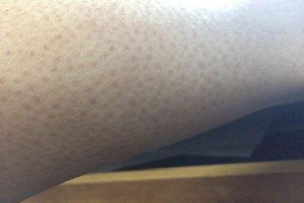 毛角周化好發(fā)于什么年齡 毛角周化什么年齡容易長