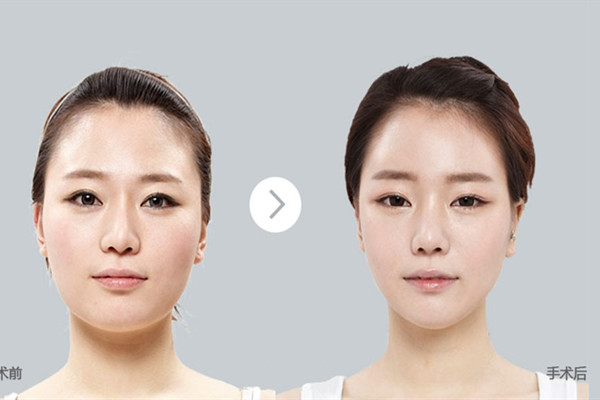 光纖溶脂是什么 光纖溶脂減肥原理 光纖溶脂是什么 光纖溶脂減肥原理