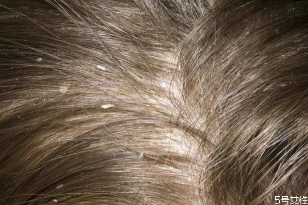 頭皮屑嚴重怎么辦 頭皮屑的解決方法 頭皮屑嚴重怎么辦 頭皮屑的解決方法