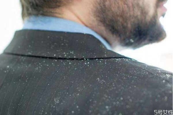 頭皮屑嚴重怎么辦 頭皮屑的解決方法 頭皮屑嚴重怎么辦 頭皮屑的解決方法