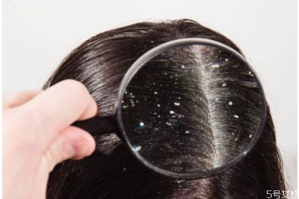 頭皮屑嚴重怎么辦 頭皮屑的解決方法 頭皮屑嚴重怎么辦 頭皮屑的解決方法