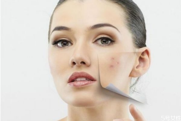 針清痘痘后多久會(huì)好 針清的注意事項(xiàng) 針清痘痘后多久會(huì)好 針清的注意事項(xiàng)