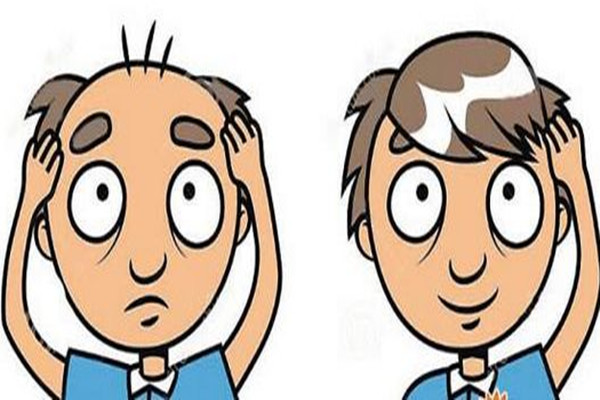 自體毛發(fā)種植的原理 自體毛發(fā)種植的特點(diǎn) 自體毛發(fā)種植的原理 自體毛發(fā)種植的特點(diǎn)