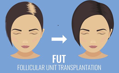 自體毛發(fā)種植多少錢(qián) 自體毛發(fā)種植哪一步最關(guān)鍵