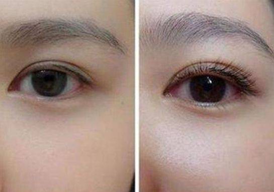 睫毛種植需要麻醉嗎 睫毛種植痛嗎 睫毛種植需要麻醉嗎 睫毛種植痛嗎