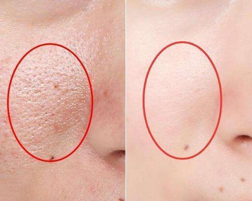 毛孔粗大怎么辦 預(yù)防毛孔粗大的方法 毛孔粗大怎么辦 預(yù)防毛孔粗大的方法