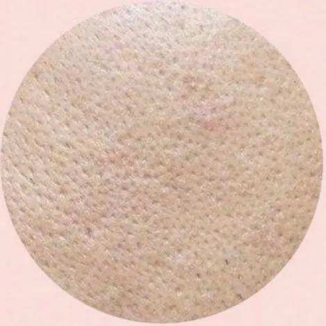 毛孔粗大怎么辦 預(yù)防毛孔粗大的方法 毛孔粗大怎么辦 預(yù)防毛孔粗大的方法