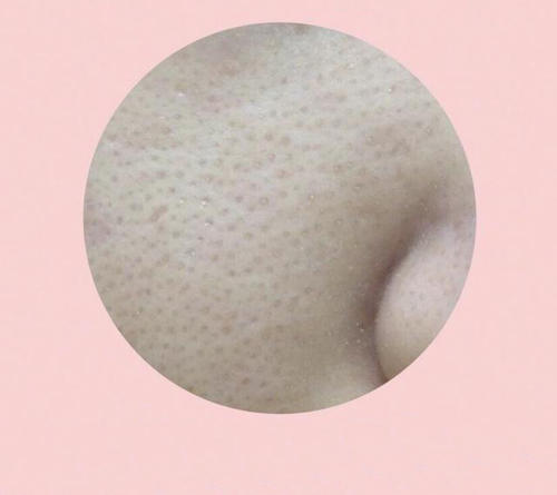 毛孔粗大怎么辦 預(yù)防毛孔粗大的方法 毛孔粗大怎么辦 預(yù)防毛孔粗大的方法