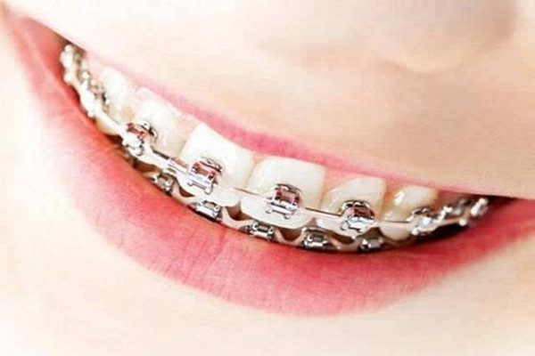 牙縫大能做矯正嗎 牙齒矯正后要注意什么 牙縫大能做矯正嗎 牙齒矯正后要注意什么