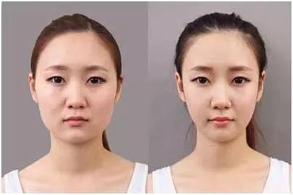 刮痧瘦臉安全嗎 刮痧瘦臉靠譜嗎 刮痧瘦臉安全嗎 刮痧瘦臉靠譜嗎