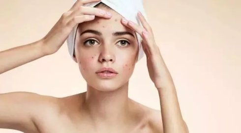 長痘痘后要注意什么 長痘痘后怎么辦 長痘痘后要注意什么 長痘痘后怎么辦