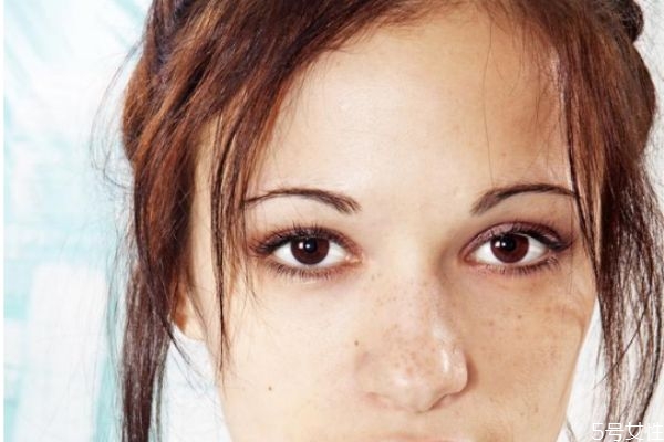 如何去除臉上的斑 怎樣消除臉上的斑 如何去除臉上的斑 怎樣消除臉上的斑