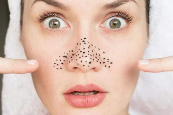 學(xué)生黨應(yīng)該怎么去黑頭 學(xué)生黨去黑頭的方法 學(xué)生黨應(yīng)該怎么去黑頭 學(xué)生黨去黑頭的方法