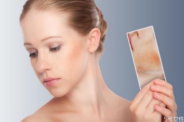 只有鼻子出油是混油嗎 臉上毛孔出油怎么回事 只有鼻子出油是混油嗎 臉上毛孔出油怎么回事