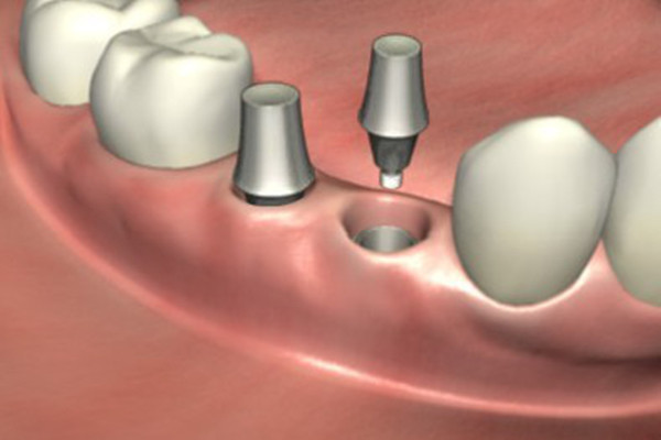 種植牙齒要注意什么 種植牙齒不能吃什么 種植牙齒要注意什么 種植牙齒不能吃什么