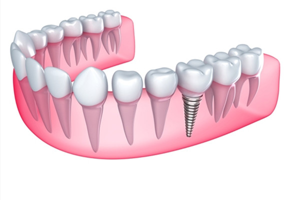 種植牙齒二期幾天能拆線(xiàn) 種植牙齒多久能好 種植牙齒二期幾天能拆線(xiàn) 種植牙齒多久能好