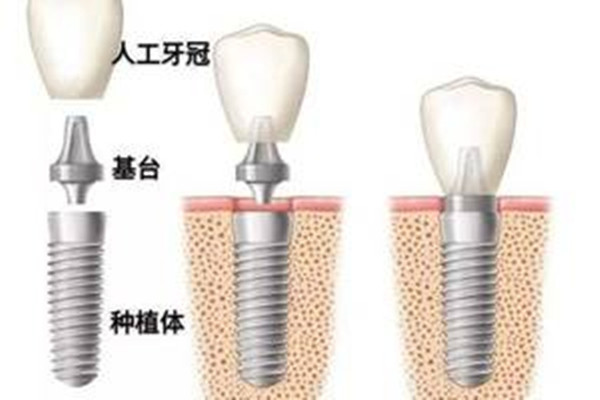種植牙齒的好處 種植牙齒的優(yōu)點(diǎn) 種植牙齒的好處 種植牙齒的優(yōu)點(diǎn)