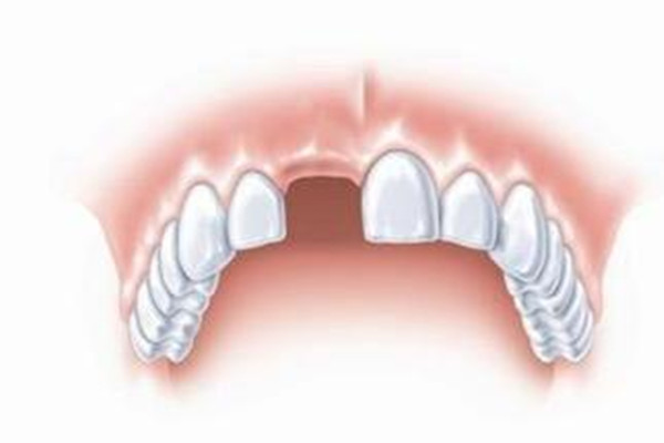 什么情況下適合種植牙齒 種植牙齒分為幾個(gè)階段 什么情況下適合種植牙齒 種植牙齒分為幾個(gè)階段