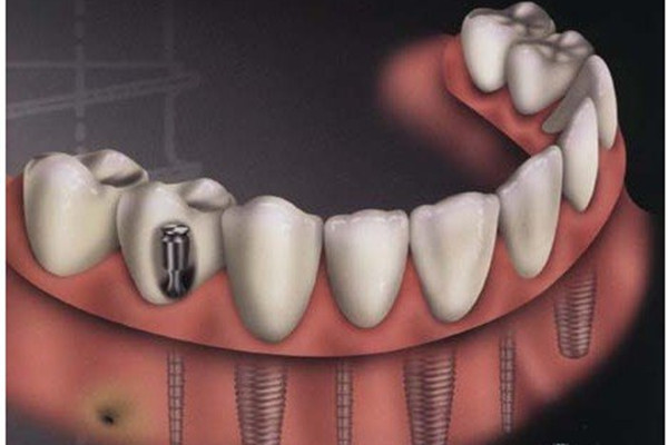 種植牙齒的危害 種植牙齒的副作用 種植牙齒的危害 種植牙齒的副作用