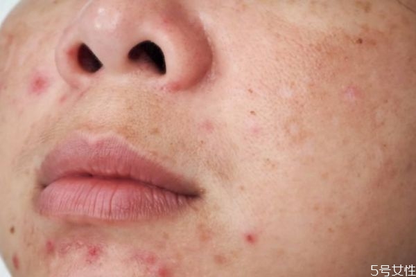 黑色痘印能自己消失嗎 黑色痘印自己可以消失嗎 黑色痘印能自己消失嗎 黑色痘印自己可以消失嗎