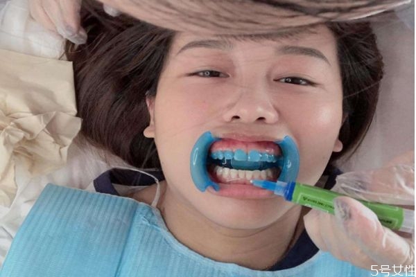 冰瓷美牙有什么危害 冰瓷美牙的副作用 冰瓷美牙有什么危害 冰瓷美牙的副作用