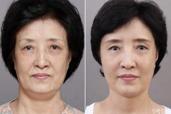 熱瑪吉五代疼不疼 第五代熱瑪吉效果 熱瑪吉五代疼不疼 第五代熱瑪吉效果