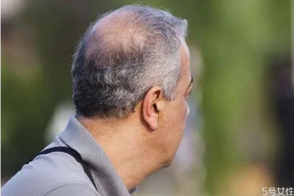 男生脫發(fā)的原因是什么 什么會導(dǎo)致脫發(fā)男生 男生脫發(fā)的原因是什么 什么會導(dǎo)致脫發(fā)男生