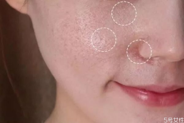 光子嫩膚后一定要醫(yī)用面膜嗎 光子嫩膚后怎么補(bǔ)水 光子嫩膚后一定要醫(yī)用面膜嗎 光子嫩膚后怎么補(bǔ)水