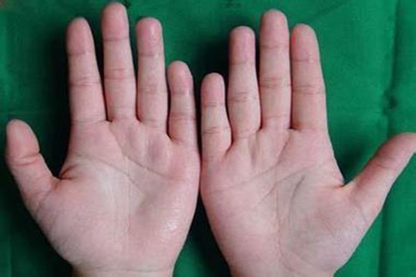 手汗癥能自愈嗎 手汗癥太嚴(yán)重怎么辦 手汗癥能自愈嗎 手汗癥太嚴(yán)重怎么辦