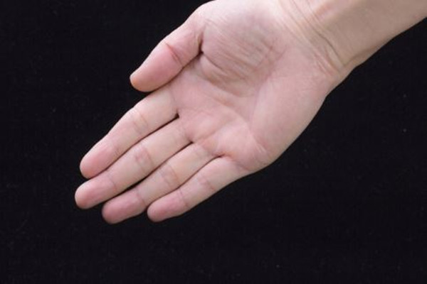 手汗癥能自愈嗎 手汗癥太嚴(yán)重怎么辦 手汗癥能自愈嗎 手汗癥太嚴(yán)重怎么辦