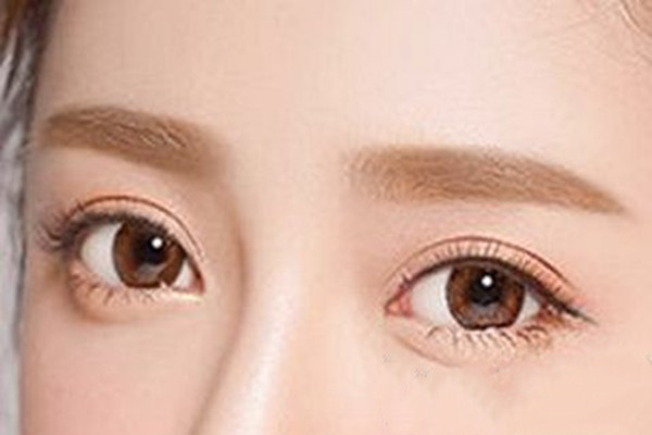 雙眼皮吸脂的原理 雙眼皮吸脂的效果好嗎 雙眼皮吸脂的原理 雙眼皮吸脂的效果好嗎