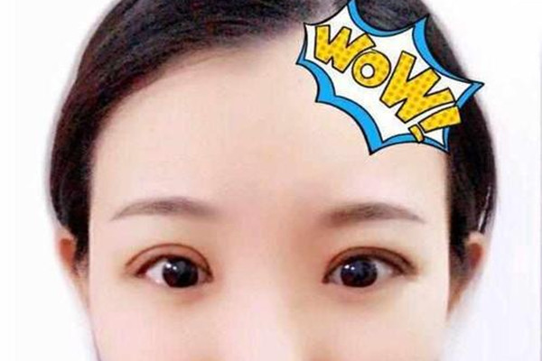 為什么壓雙眼皮看起來(lái)有緊繃感 術(shù)后眼睛要做哪些運(yùn)動(dòng) 為什么壓雙眼皮看起來(lái)有緊繃感 術(shù)后眼睛要做哪些運(yùn)動(dòng)