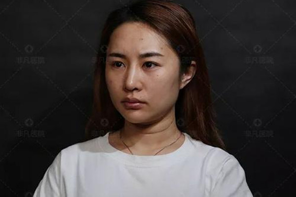 壓雙眼皮多久能消腫 壓雙眼皮的恢復(fù)過程是怎樣的 壓雙眼皮多久能消腫 壓雙眼皮的恢復(fù)過程是怎樣的