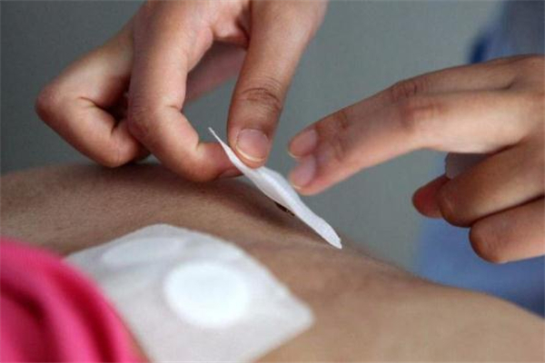 三伏貼一次貼幾張 貼三伏貼要忌口多長時(shí)間 三伏貼一次貼幾張 貼三伏貼要忌口多長時(shí)間