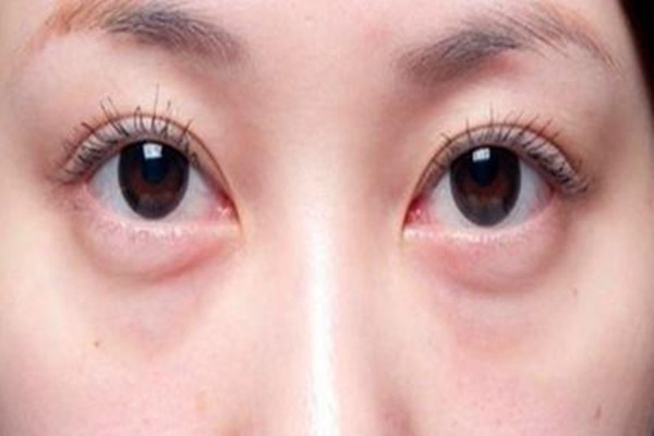 眼袋出現(xiàn)的原因 韓式去眼袋有效果嗎 眼袋出現(xiàn)的原因 韓式去眼袋有效果嗎