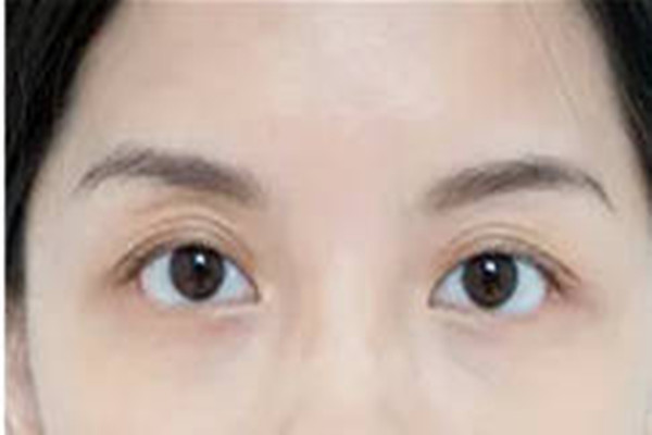 韓式去眼袋第二天會腫嗎 韓式去眼袋的注意事項 韓式去眼袋第二天會腫嗎 韓式去眼袋的注意事項