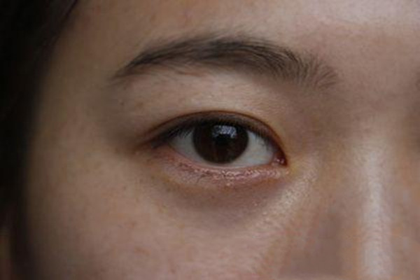 ?無痕去眼袋真的無痕嗎 無痕去眼袋術(shù)前注意事項 ? ?無痕去眼袋真的無痕嗎 無痕去眼袋術(shù)前注意事項 ?