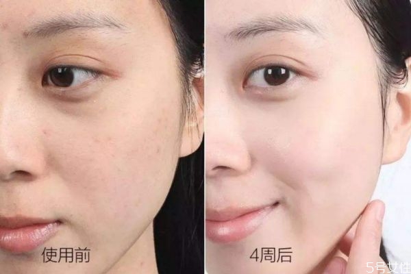 額頭長(zhǎng)閉口是什么情況 為什么額頭反復(fù)長(zhǎng)閉口