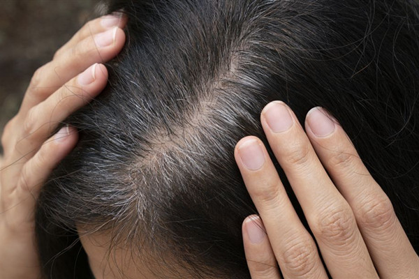 什么是毛發(fā)移植 毛發(fā)移植安全嗎 什么是毛發(fā)移植 毛發(fā)移植安全嗎